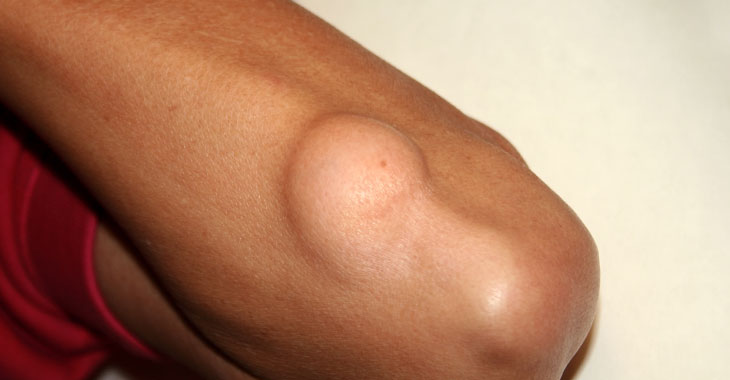 lipoma on arm