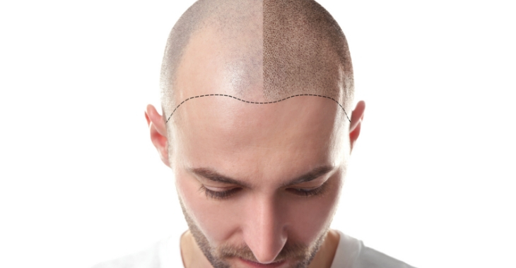 Hair Transplant