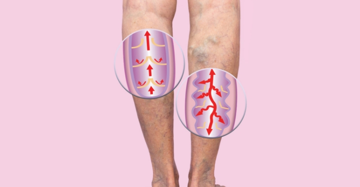 Varicose Vein Treatment