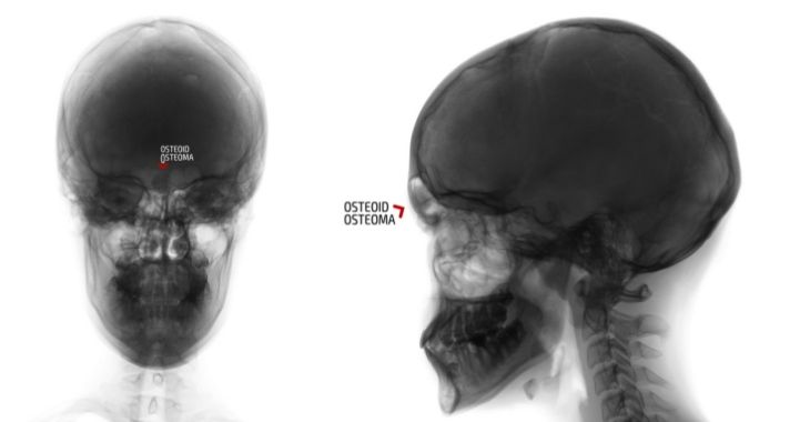 Osteoma