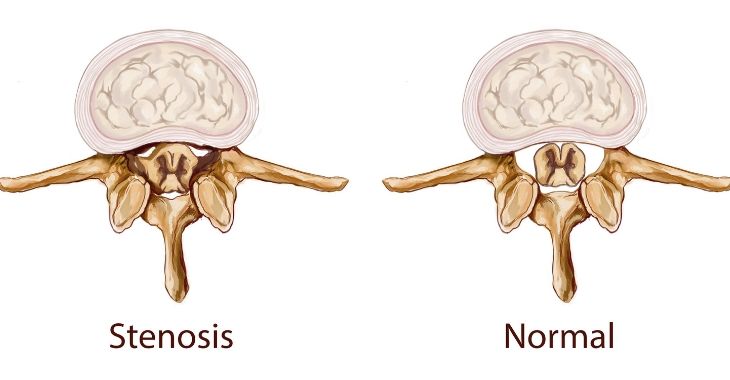 Stenosis