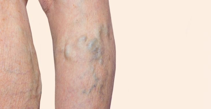 Deep Vein Thrombosis