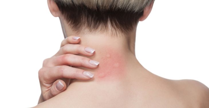 Rash Treatment