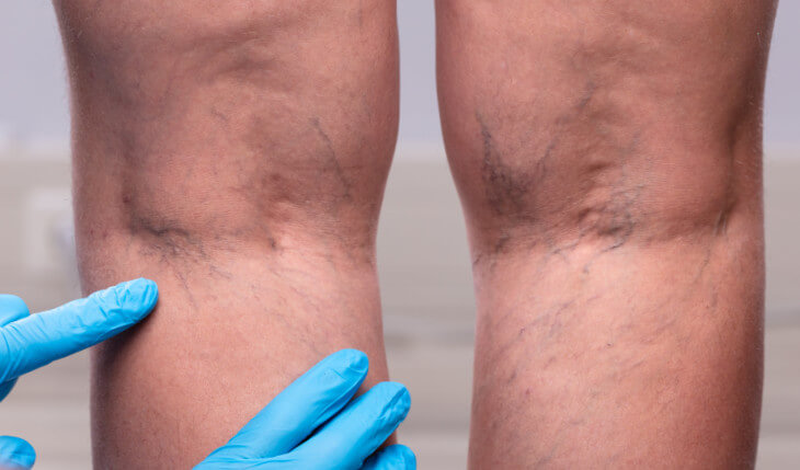a picture of blood clots in legs