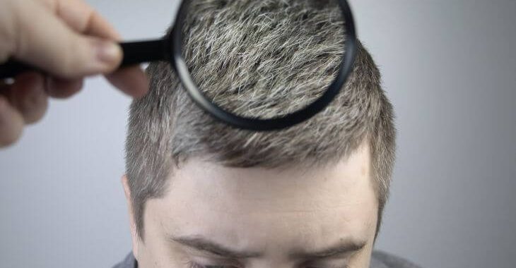 Trychologist examining graying hair of a young man suffering from Marie Antionette Syndrome.