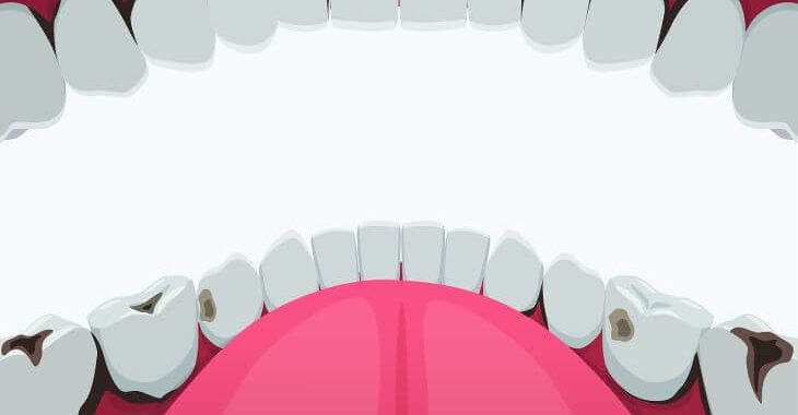 Teeth with different stages of cavity.