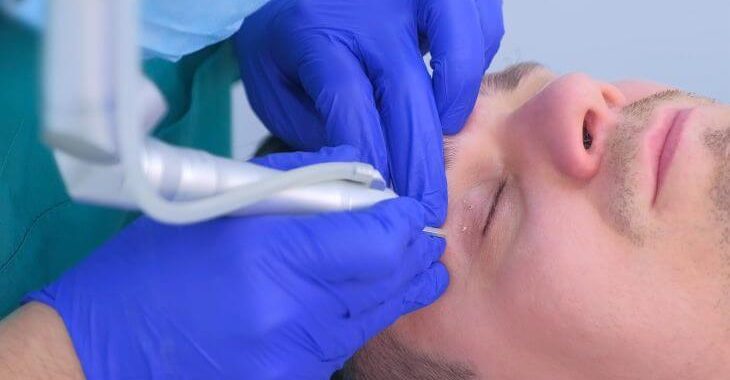 A man having skin tags on eyelid removed.