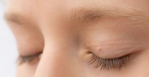do skin tags on eyelids go away do skin tags on eyelids go away