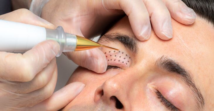 A man undergoing non-surgical skin tightening procedure.