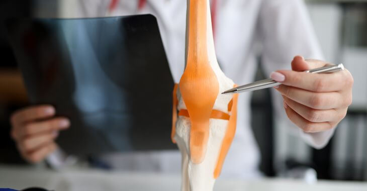 A doctor revising knee x-rays and explaining the knee joint replacement surgery on a model.