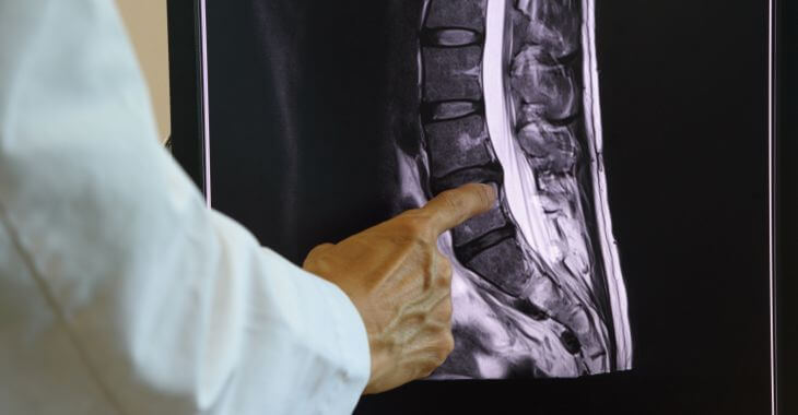 A doctor revising an MRI image and pointing at a damaged lumbar area.