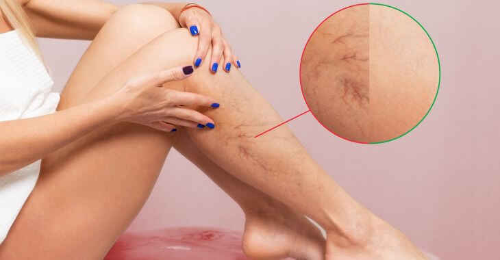 Woman looking at spider veins on her legs.