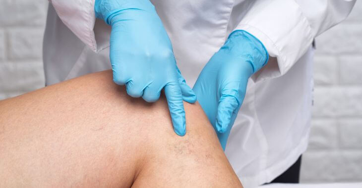 A doctor examining patient's leg veins.