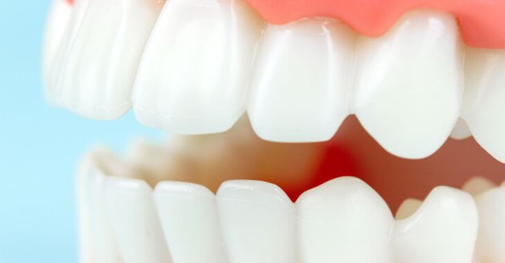 Teeth Covers The Types And Their Costs Dentakay 55 OFF