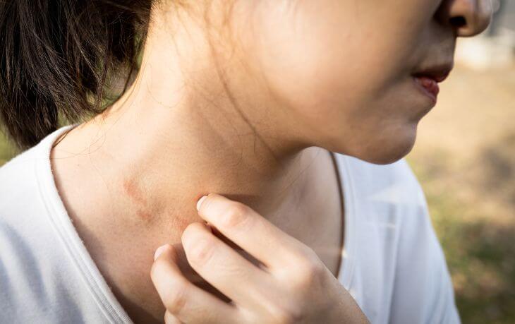 An Asian young woman with blisters caused by spongiotic dermatitis scratching the itchy skin on her neck.