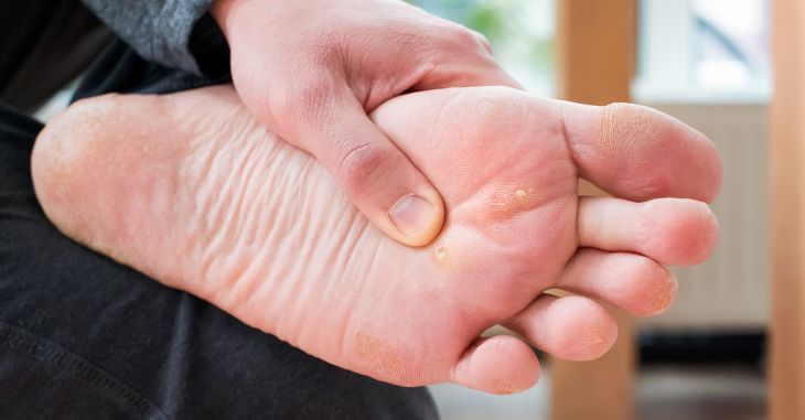 A man with growths on foot watching his foot sole.