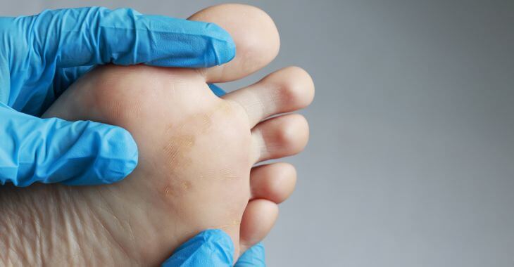 A doctor examining foot of a patient with a growth on a sole. 