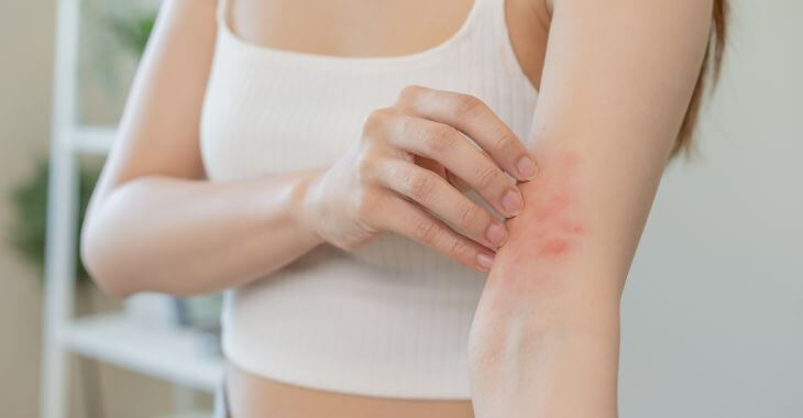 Woman scratching itching inflamed skin on her arm with redness caused by spongiotic dermatitis.