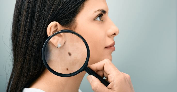 A dermatologist with a magnifying glass looking at skin lesions on woman's neck to determine if they are birthmarks or moles.