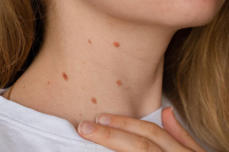 A young woman's neck covered with moles and birthmarks.