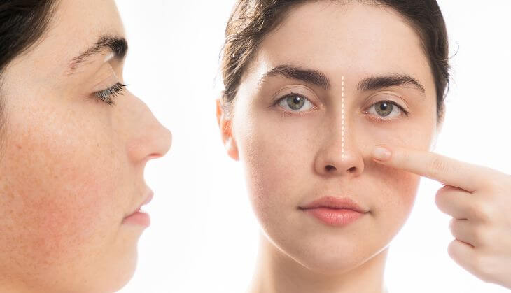 Woman's nose before and after reshaping 