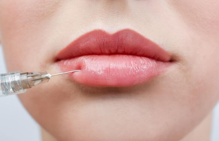Lip filler injectable treatment
