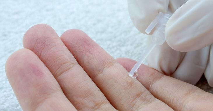 A dermatologist applying topical cantharidin on patient's hand wart