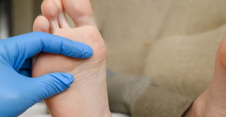 A dermatologist examining a foot of a patient with plantar wart