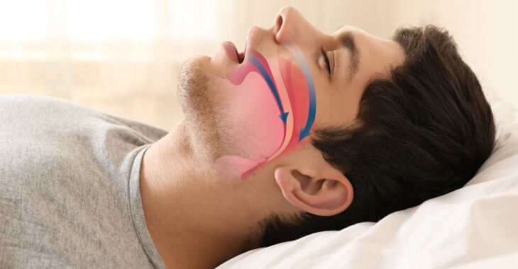 an image of a sleeping man suffering from sleep apnea with arrows showing airflow