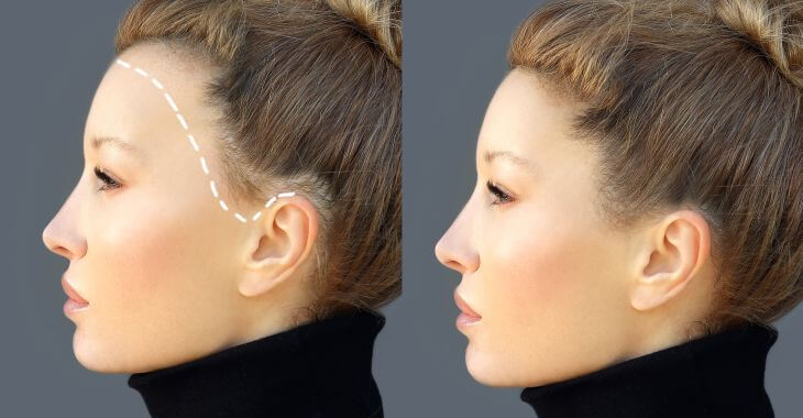 Face profile of a woman before and after hair transplant for forehead lowering