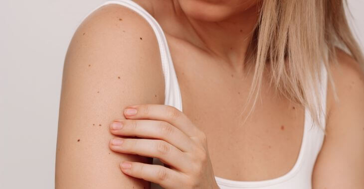 Woman checking skin moles and spots on her arm