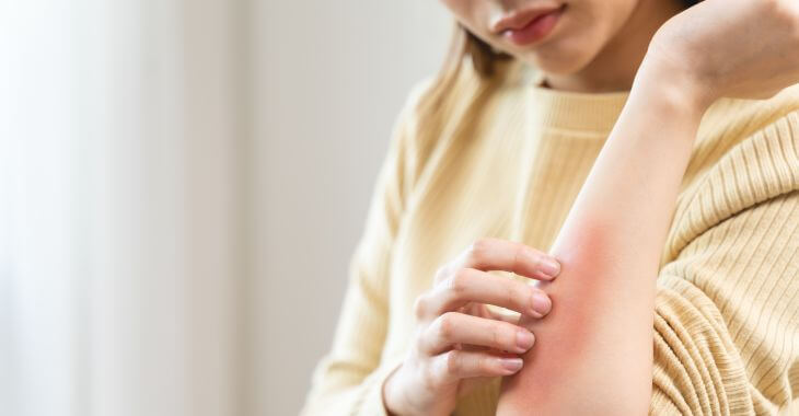 Woman with skin rash on her elbow and forearm rubbing skin